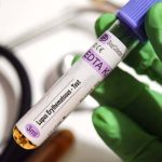 کشف قوی‌ترین شواهد از نقش ویروس اپشتین بار در بروز بیماری لوپوس